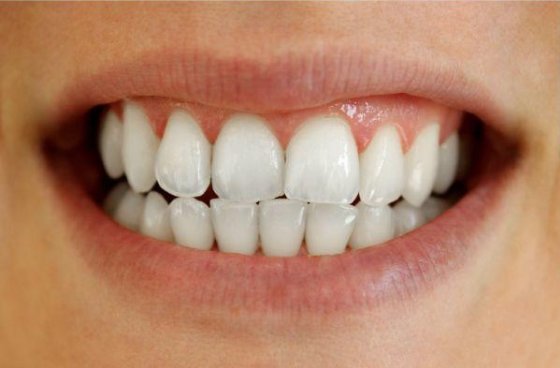 Teeth after whitening