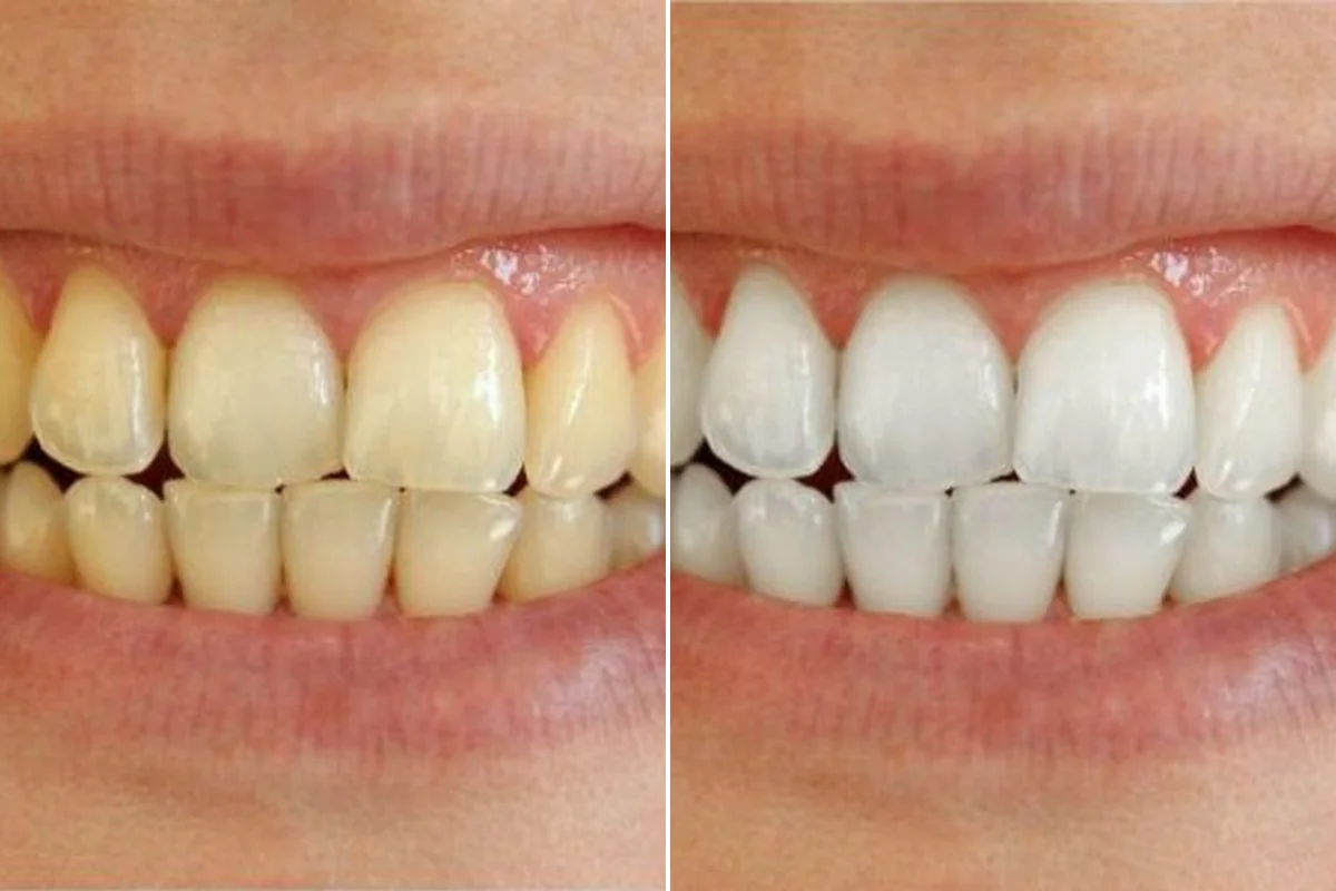 Teeth before and after whitening, side by side