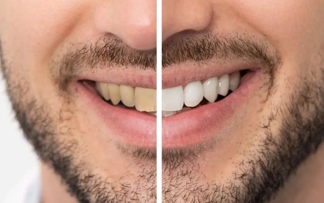Smile before and after whitening, split down the middle